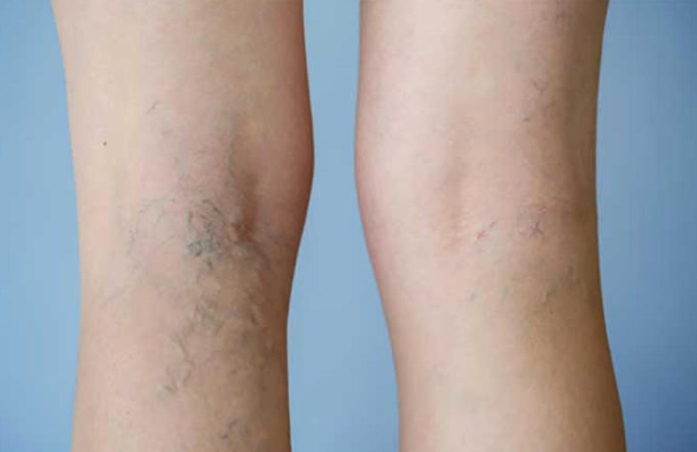 6 Fantasies About Varicose Veins That Many Individuals Trust