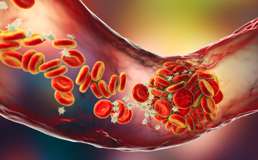 embolism