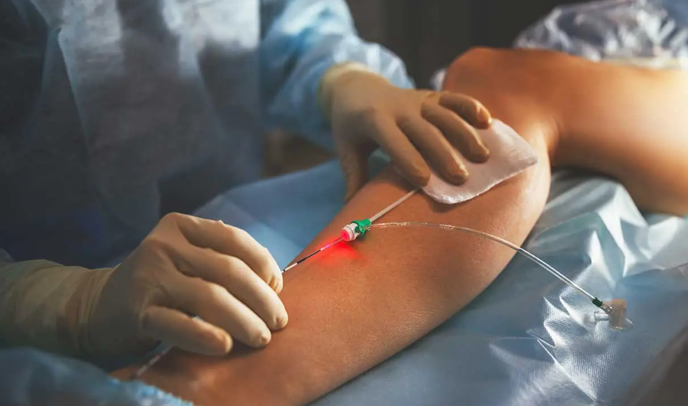 Instructions to dispose of varicose veins normally through surgery