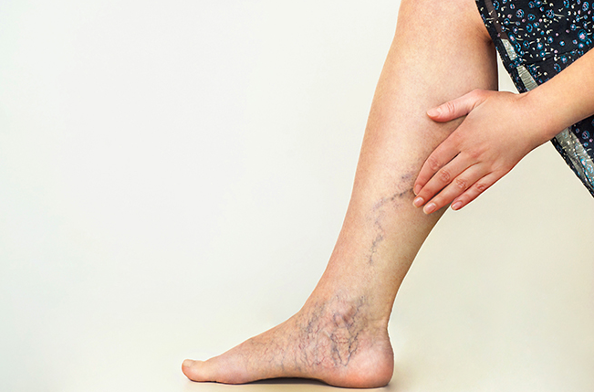 varicose veins in the legs