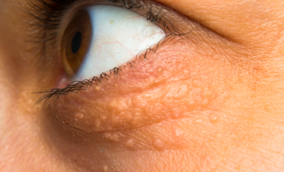Xanthoma, chunks of fat on the skin because of elevated cholesterol